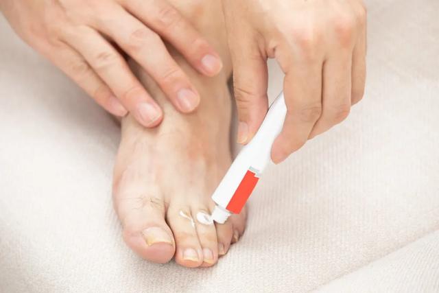 脚气反复发作该如何根治？不同类型该选那种药膏？丨药师说药