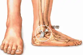脚崴真不是小事！厦门男子扭伤后没在意，两天后走路竟成了难题图片