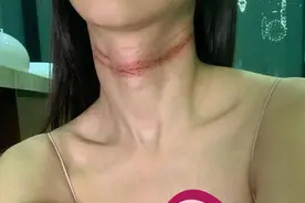 李云迪女弟子半夜上吊自杀未遂，公开颈部血痕照还原试图轻生始末图片