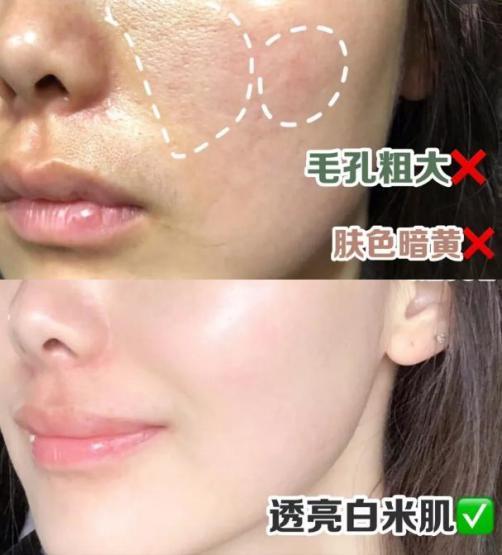 去粉刺毛囊炎痤疮鸡皮身体乳