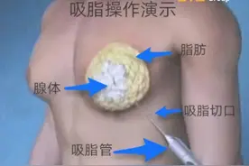 小伙乳房发育减肥也减不掉！ 哈医大一院乳腺外科无痕手术解决男性乳房发育困扰图片