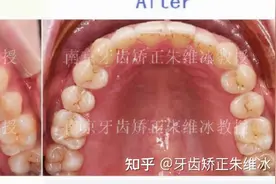 南京牙齿矫正｜前牙严重扭转，利用隐适美轻力优势规避骨开窗风险图片
