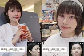 34岁广东女生，颧骨突出显刻薄苦相，脂肪填充后美成人间富贵花图片