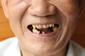 老人牙齿越来越差，多数是这3个误区造成的图片