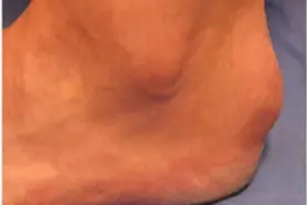 脚后跟上长个硬包，一走路就痛，好怕是“不好的东西”图片