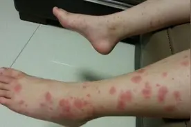 孩子双下肢有这种皮疹要注意，严重会引起肾脏病变图片