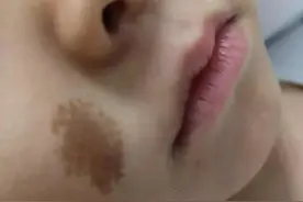 斑有很多种，治疗大不同图片