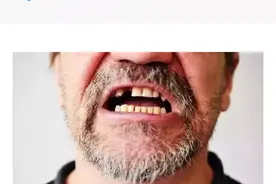 人民日报：牙齿缺失会折寿10年！缺牙的后果比你想象的严重图片