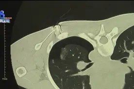 工地上玩射钉枪，钉子伤到孩子肺部图片