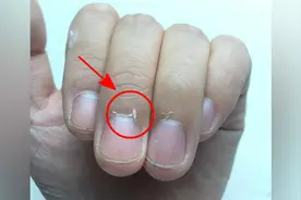 指甲边长倒刺，是身体有什么问题吗？视频封面