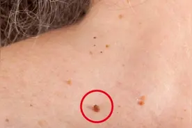 脖子上为何会出现小肉粒？对身体有伤害吗？若是这两种就要注意图片