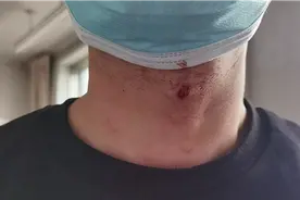 生命边缘 耳鼻喉科引入眼科特殊器械巧取异物图片