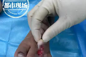 痛得心揪着！南昌3岁男童“搬石头砸了自己脚”，2根脚趾砸断图片