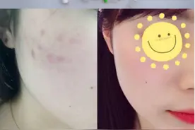 敏感肌妹纸怎么去闭口，种草给你们，超级实用哦！️图片