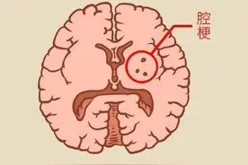 发现腔梗，就要吃阿司匹林吗？医生提醒：做到这5件事更重要图片