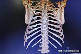 CT平扫、薄层CT、增强CT、CT三维重建怎样分别？这样好理解图片