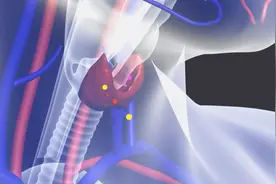 什么是甲状腺机能亢进？多引起心悸、出汗、体重减少等症状视频封面