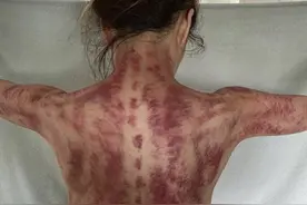 天后郑秀文晒刮痧照，网友直呼娱乐圈越来越注重养生了图片