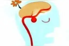 颅内动脉瘤，我们有十八般武艺对付你！图片