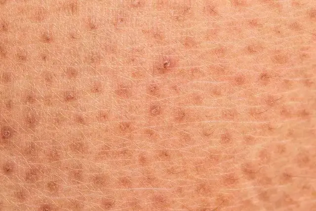 鸡皮肤来看一招改善没那么难