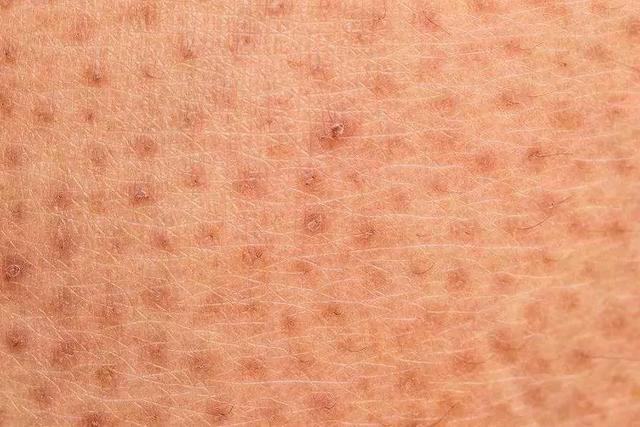 百想膏治鸡皮肤吗 百想膏治鸡皮肤吗