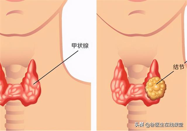 甲状腺胶质结节和结节的区别 2026年甲状腺胶质结节和结节的区别图片