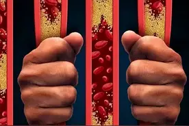 世界血栓日｜手脚发凉、怕冷，走路小腿酸困，当心“不死癌症”——脉管炎图片