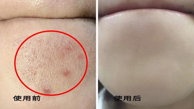 洗面奶中这2种网红护肤成分叠加使用：温和清洁+除螨杀菌＞2？