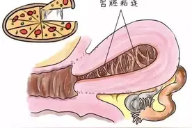 医生，我好好的宫腔怎么就粘连了呢？图片