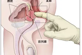 为什么现在前列腺癌越来越多了？前列腺癌和*生活有关系吗？图片