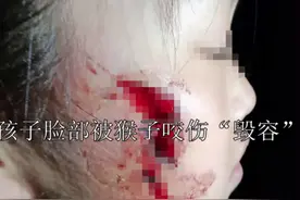 野猴子咬破小孩头盖骨后续！当地政府：已高度重视图片