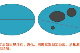 医生怎么判断治疗效果好不好？一文读懂“疗效评估”图片
