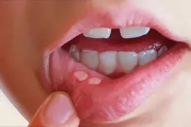 快速认识口腔溃疡及我的经验治疗，效果显著图片