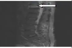 骨质疏松性胸腰椎骨折MRI STIR黑色线性信号与外力程度的关系图片