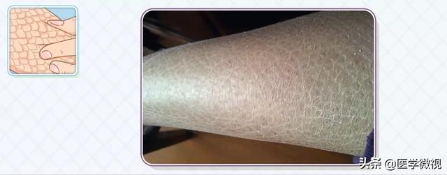 我的x性连锁鱼鳞病经历 我的x性连锁鱼鳞病经历