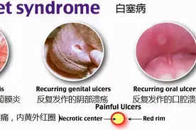 深圳男子口腔溃疡8年，还蔓延全身！竟是这种怪病！图片