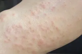 叫了很多年的“湿疹”，原来还不是一种病？图片