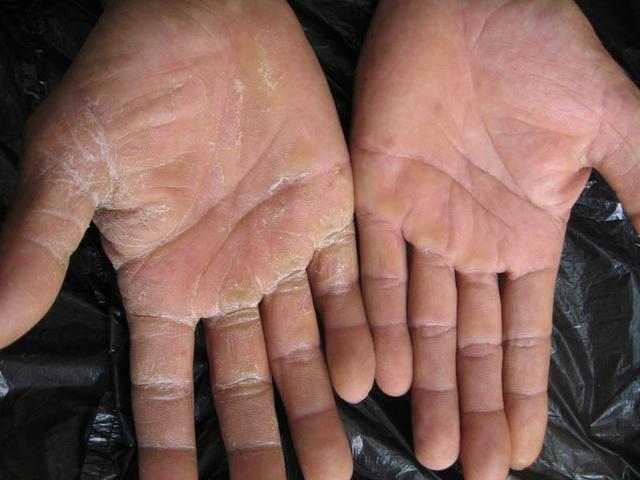 角化皲裂型手癣涂什么药膏好