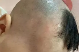婆婆偷偷给宝宝剃光头，第二天头皮变成了这样……心疼图片