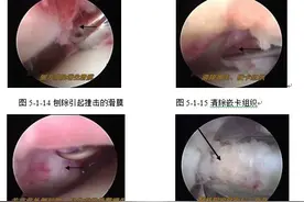 踝关节撞击综合症图片
