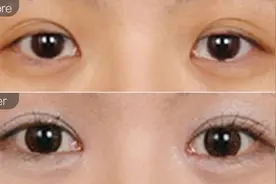 想开内眼角？看完这篇文章，你再决定要不要开眼角吧图片