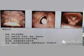【特殊病例】这样的气道，怎样麻醉插管？图片