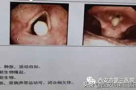 【特殊病例】这样的气道，怎样麻醉插管？图片