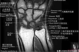 腕关节磁共振（MRI）解剖--精品图集图片