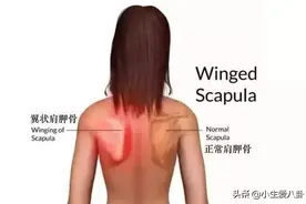 郑爽的“蝴蝶背”上了热搜！大家肯定十分羡慕！究竟是美还是病？图片