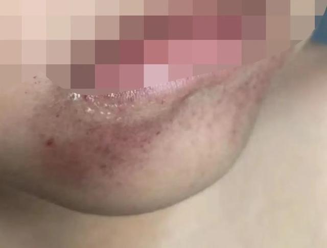 皮肤上出现很多小红点 皮肤上出现很多小红点