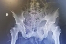 男子伐木被砸伤骨盆严重骨折，骨科医生手术助他康复图片