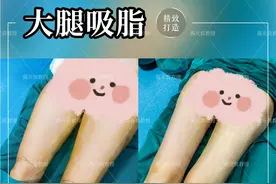 大腿环吸后，大腿根部皮肤凹凸不平是怎样回事？图片