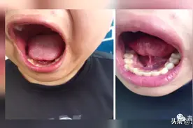 孩子说话“大舌头”，可能是这里有问题...图片