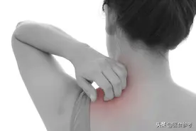 秋季里那些被荨麻疹折磨的人，需不需要“忌口”？图片